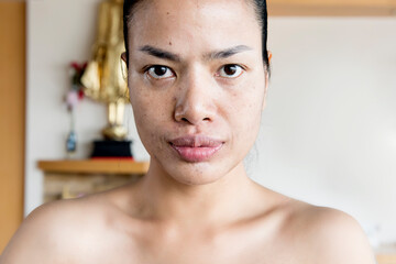 Fototapeta na wymiar Women who have problems with dry skin and turn to flaky skin