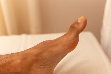 Detalhe de agulha de acupuntura em pé de paciente.