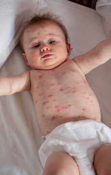 Toddler with chicken pox 