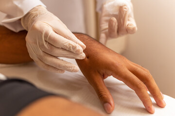 Obraz na płótnie Canvas Terapeuta aplicando agulhas de acupuntura em mão de paciente.