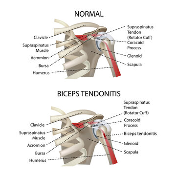 biceps tendonitis, shoulder joint, realistic vector illustration
