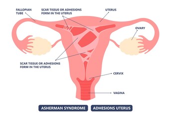 Asherman's uterus scar tissue cervix wall pelvic pain trauma and genital tube cramps abnormal injury deposit tract cancer HSG no period ovary PCOS polyp fibroid menstruation cycle loss