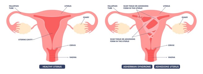Asherman's uterus scar tissue cervix wall pelvic pain trauma and genital tube cramps abnormal injury deposit tract cancer HSG no period ovary PCOS polyp fibroid menstruation cycle loss inflammation