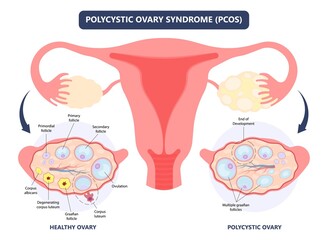 Obraz premium Cancer pelvic PCOS ovary Endo belly pain swelling uterus heavy ovaries cysts examine surgery remove pregnancy endobelly tube cycle period Fertility problem diagnosis menstruation cell polyp cervical