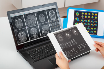 Neurology student while studying and consulting different medical reports of a brain exams. Doctor comparing spect and datscan test of a neurological patient to make a diagnosis. Brain pathology image