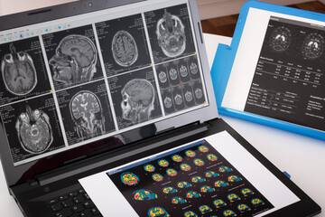 Neurology student while studying and consulting different medical reports of a brain exams. Doctor comparing spect and datscan test of a neurological patient to make a diagnosis. Brain pathology image