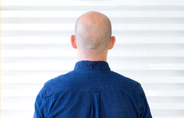 Person without hair on his back with blue shirt and white background
