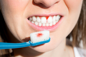 Woman with bleeding gums during teeth brushing. Hard toothbrush problem. Periodontal disease,...