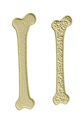 Femur bone cut in half showing normal bone density and osteoporosis