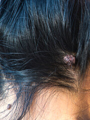 Skin Tag, Acrochordon on Female's Head.