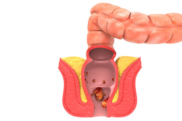 Naklejka premium Haemorrhoids (piles) on white background. 3d illustration