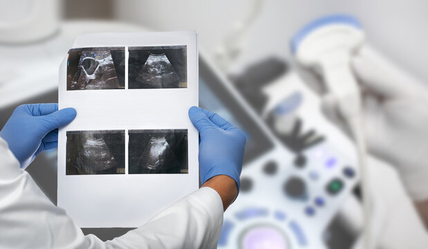 Result of ultrasound of the gallbladder and internal organs. Diagnosis of diseases of the gallbladder by ultrasonography