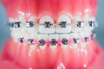 The braces are placed on the teeth in the artificial jaw. Macro photography
