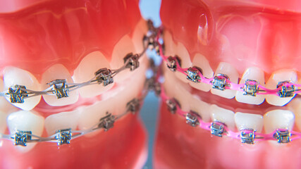 The braces are placed on the teeth in the artificial jaw. Macro photography