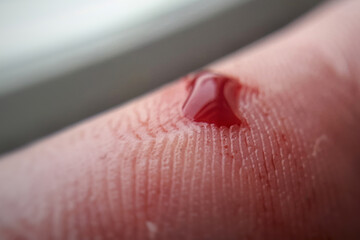 Macro of a finger with a drop of blood. Bleeding blood from the cut finger wound. Injured finger...