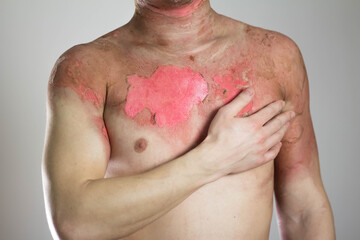 Man with a severe burn all over his body. Close up. Isolated on a gray background