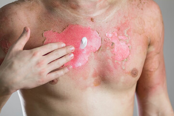 Hand rubs in the burn cream. Man with a severe burn all over his body. Close up. Isolated on a gray...