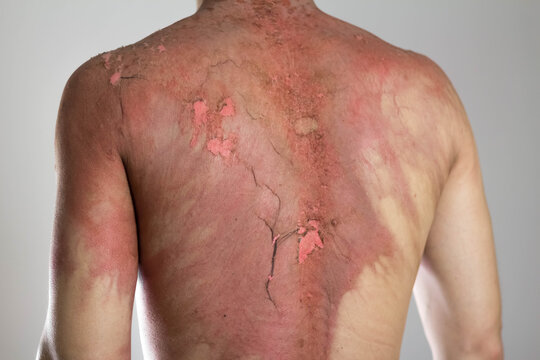 Man with a severe burn all over his body. Close up. Isolated on a gray background