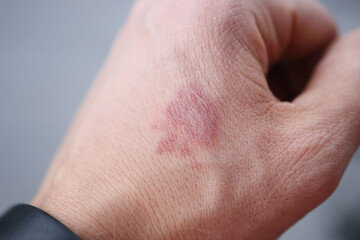 Closeup of burn stain on mans hand