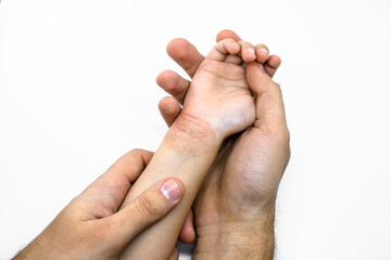 A man's hand holds a child's hand. Red dry skin food allergy