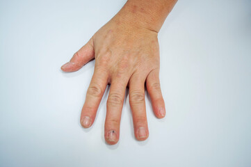 Hand with skin disease on a white background