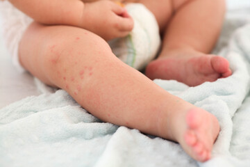 A small child with a red rash on the leg sits on the bed. Children is allergies.
