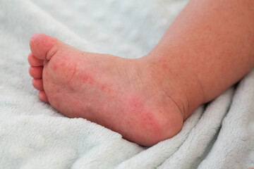 A small child with a red rash on the leg sits on the bed. Children is allergies.