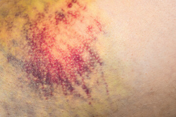 huge multi-colored bruise on body. Close-up is wounded leg with bruise and abrasion. Injured skin....