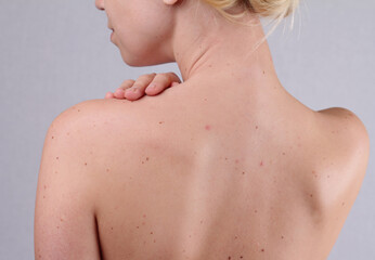 Pimples beautiful female on back, oily skin care concept
