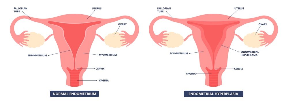 Cancer pelvic PCOS ovary Endo belly pain swelling uterus heavy ovaries cysts examine surgery remove pregnancy endobelly tube cycle period Fertility problem diagnosis menstruation cell polyp cervical
