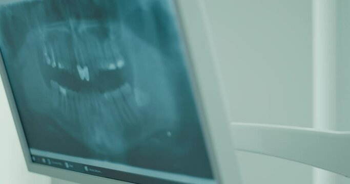 X-ray image on a screen