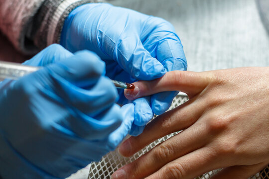 young woman doing a manicure after panaritium treatment