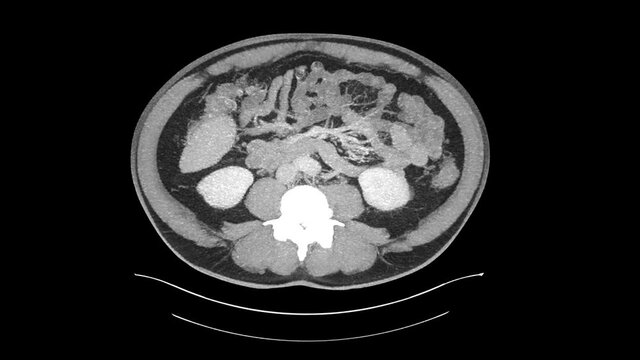 computed abdomen ct of a man in the mid 50th 