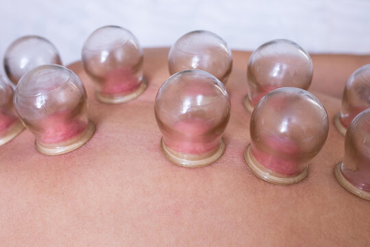 Back detail of a young man who just underwent an acupuncture fire cupping treatment. Multiple vacuum cup of medical cupping therapy on human body