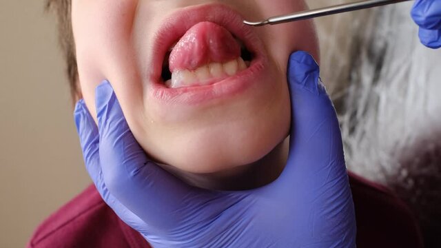 dentist, doctor examines oral cavity of small patient, concept of speech disorders, correction, frenum of tongue, methods of correctional developmental exercises