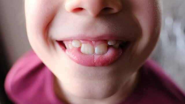 kid, child of 8 shows his teeth, tongue, concept of speech disorders, correction, methods of correctional developmental exercises