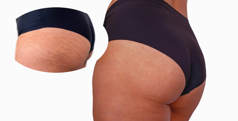 Image compare before and after Woman buttocks with stretch marks removal treatment, real people