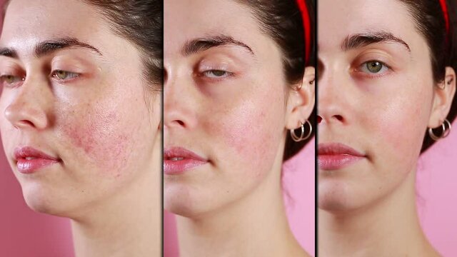Three halves of the face of a young Caucasian woman close-up showing the result before and after rosacea treatment. Split screen. Pink background. The concept of couperose and rosacea.