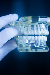 Dental tooth implant model