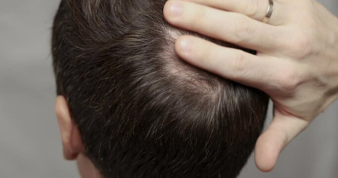 Man with hair loss problems close-up. Alopecia balding hairs on man scalp. Human alopecia or hair loss - adult person hand pointing his bald head. Scratching his head. Baldness. Depression.