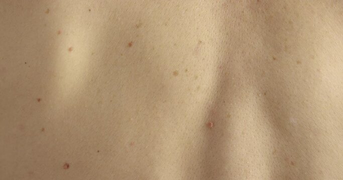 Close-up of large rashes or smallpox on the skin of an adult male. Pigmented spots on the back of a man. Skin of a man with moles. Acne. Problem skin. Skin care