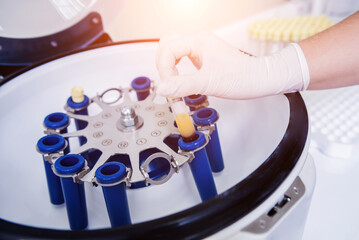 Platelet-Rich plasma preparation. Tube with plasma in hands