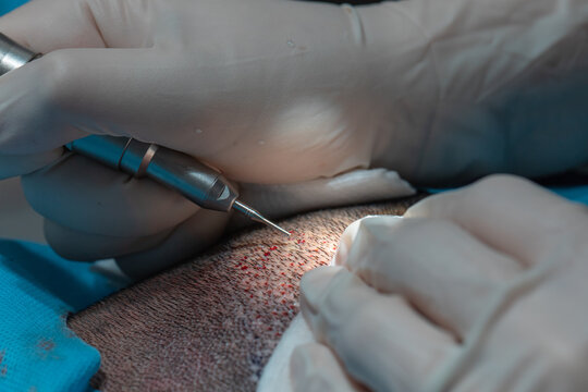 Hair Implant Process, Collecting Hair Plasma For Implanting Process