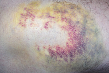 multi-colored bruise on body. Close-up is wounded leg with bruise and abrasion. Injured skin....