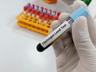 Biochemist or Lab Technologist holds Blood sample for fibrinogen level (factor 1) test, diagnosis...