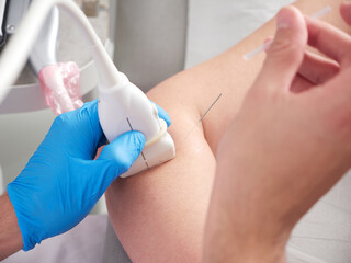 woman being treated with percutaneous electrolysis by a physiotherapist