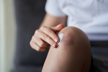 Obraz na płótnie Canvas Close up of a person rubbing cream for healing injured knee joint. Bruise on the knee. Leg pain