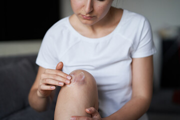Close up of a person rubbing cream for healing injured knee joint. Bruise on the knee. Leg pain