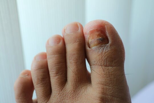 Toenail off. Foot pain of woman wearing shoes. Feet health problem.  Health care concept.
