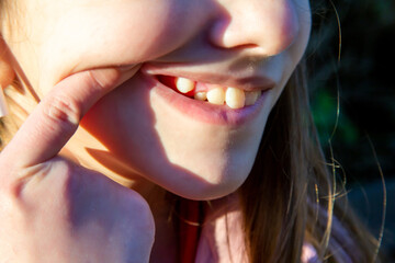 problems with children's teeth - the girl's teeth grow crookedly